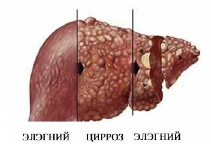 Элэгний өвчнийг эмчлэх ардын эмчилгээ