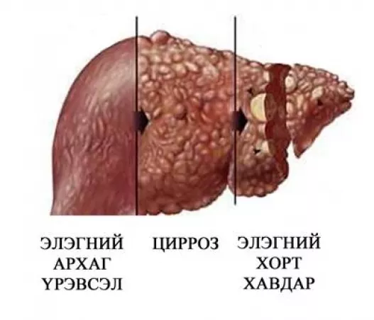 Элэгний өвчнийг эмчлэх ардын эмчилгээ